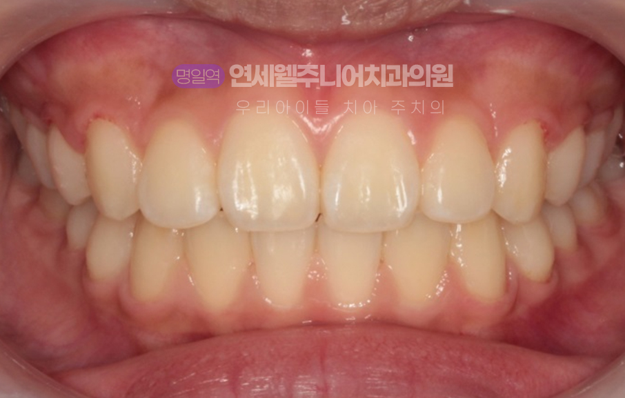 중학생 MTA 교정 후 앞니와 송곳니의 배열이 정돈된 상악 치열 정면 사진