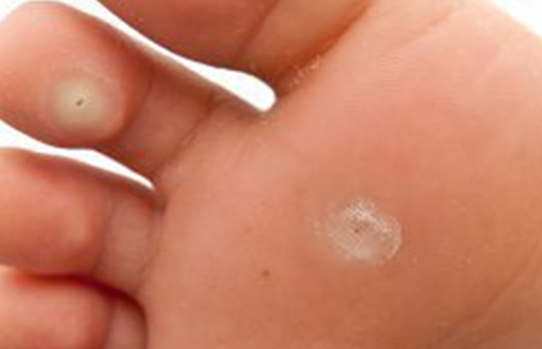 사마귀 - 종류 원인