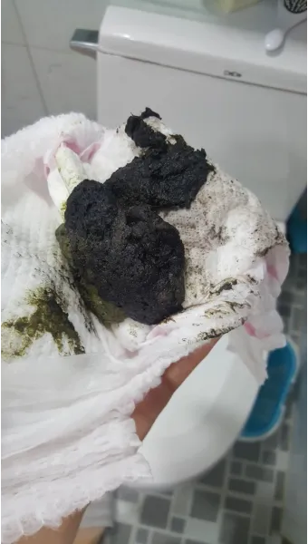 똥이 까만색 검정똥 원인과 질병 가능성_3