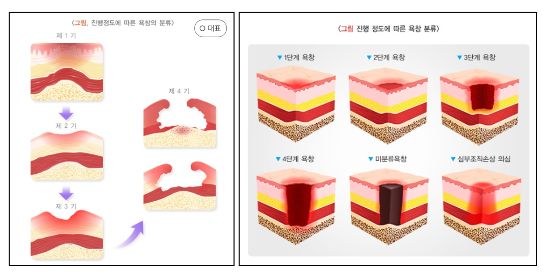 욕창에 대해