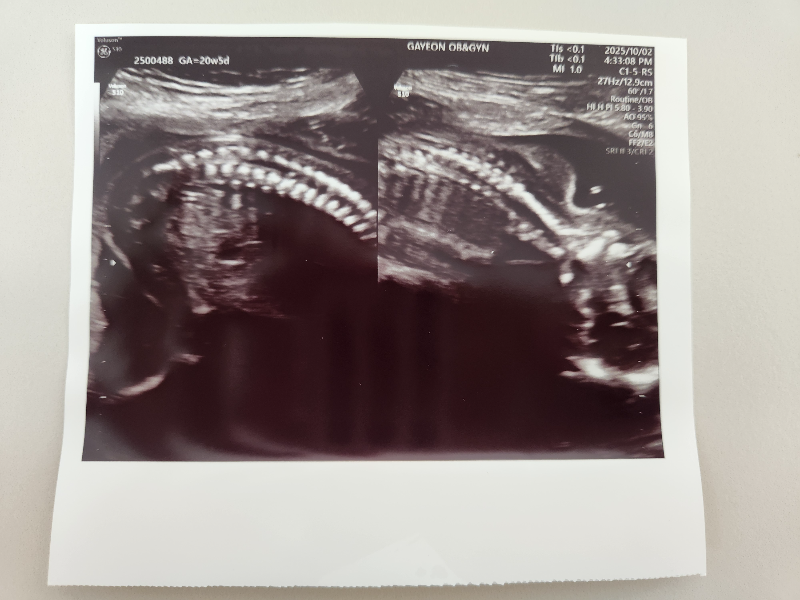 2차 정밀 초음파