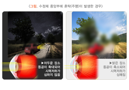 수정체 중앙부에 혼탁이 발생한 경우