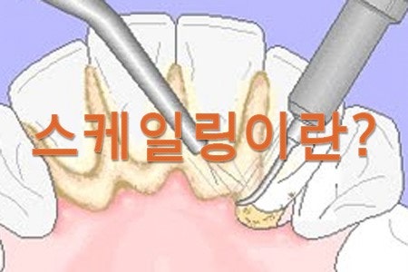 치아 스케일링 보험 적용 대상&middot;비용 총정리 관련 사진
