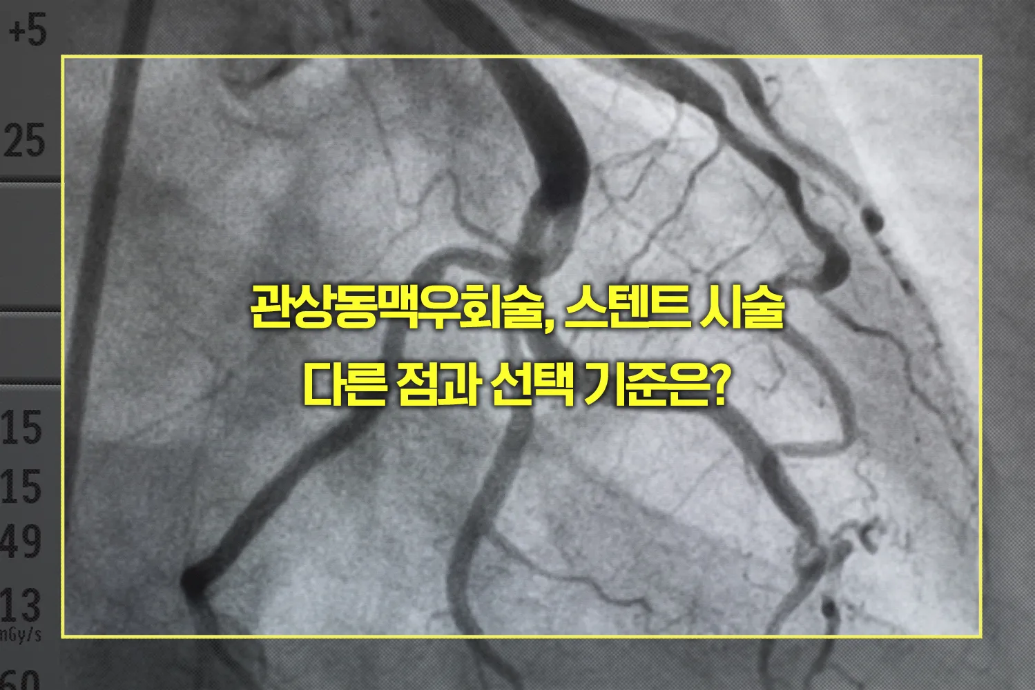 관상동맥우회술, 스텐트 시술 선택 기준