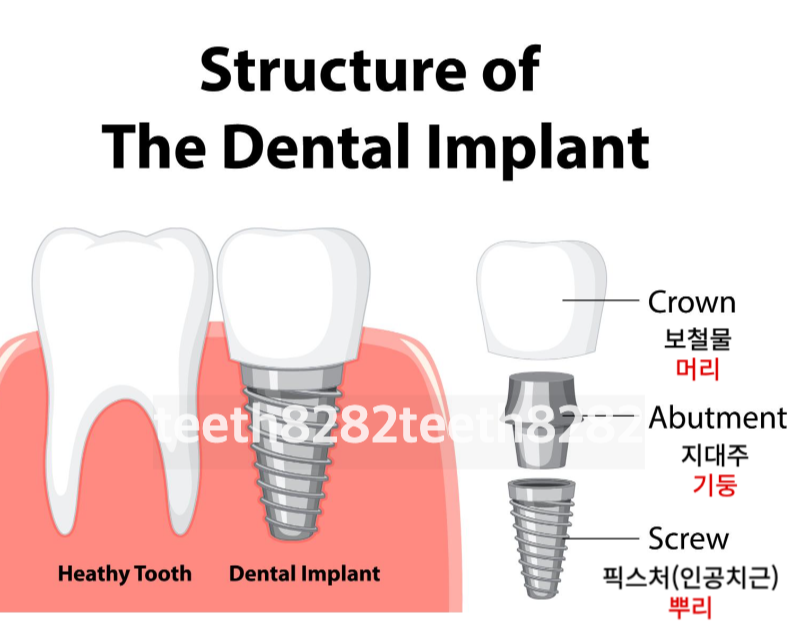임플란트-수술과정