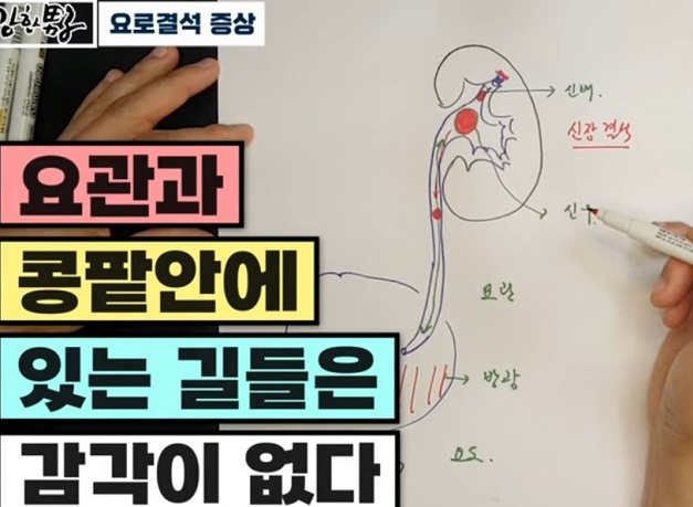 EBS명의-요로결석-증상-구교철교수