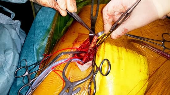 상지의 혈관 이상 &ndash; 증상과 진단 및 치료법