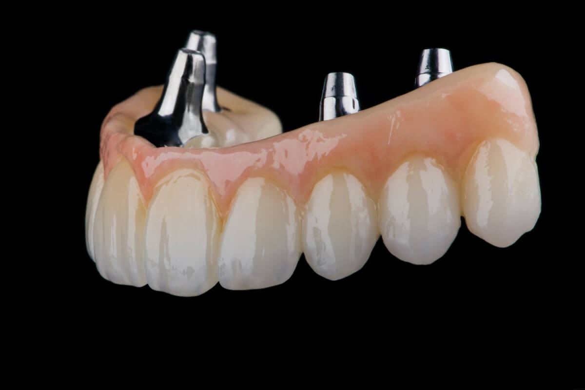 임플란트와-틀니-중-더나은것은?