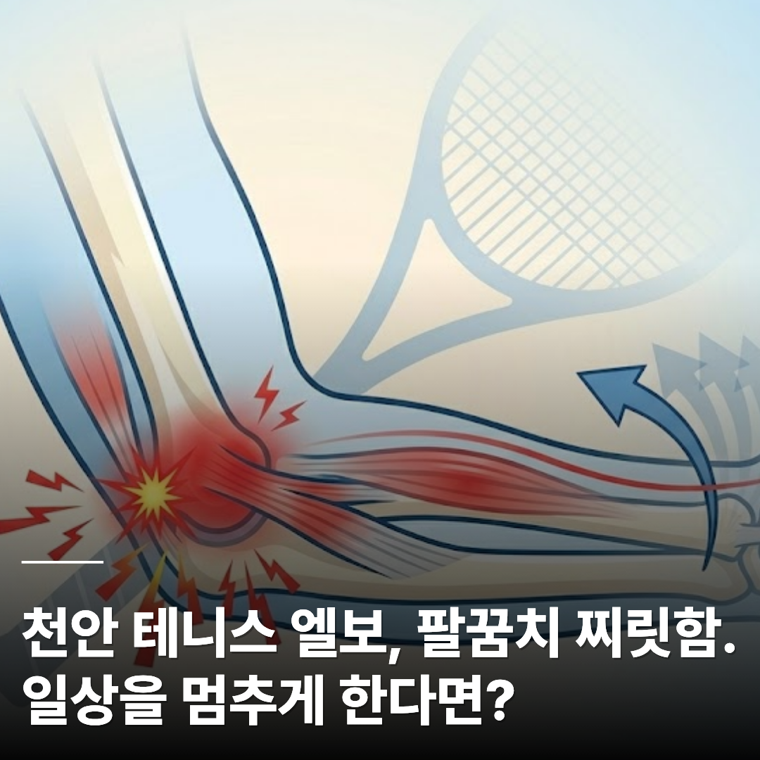 팔꿈치 관절에 붉은색으로 찌릿한 통증이 표시된 일러스트와 배경에 테니스 라켓이 희미하게 그려져 있습니다. 하단에는 '천안 테니스 엘보, 팔꿈치 찌릿함. 일상을 멈추게 한다면?'이라는 제목 문구가 적혀 있습니다.