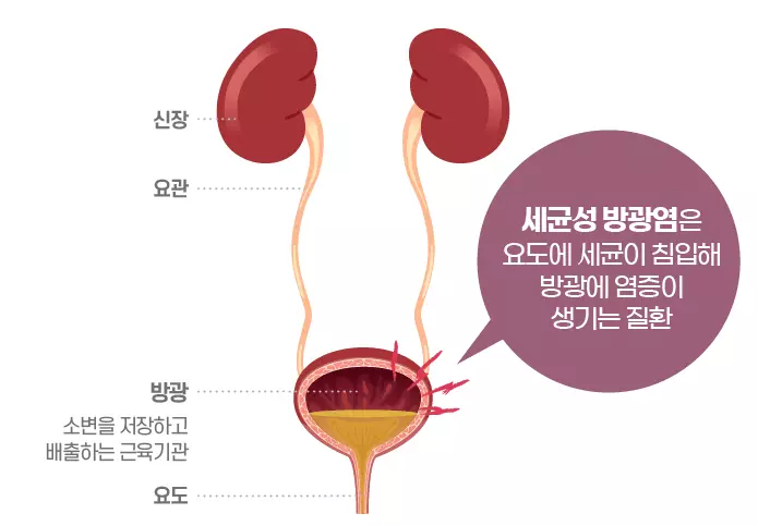 방광염 약국약 효과