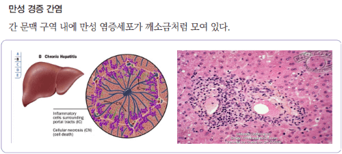 B형 간염 정의 특징 치료 예방