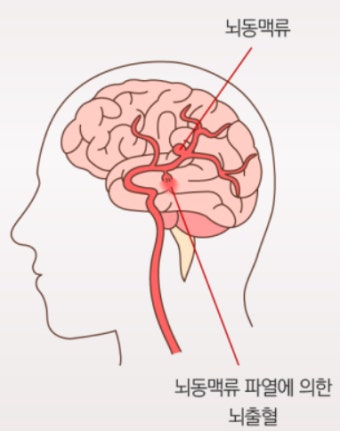 겨울, 뇌혈관이 위험하다