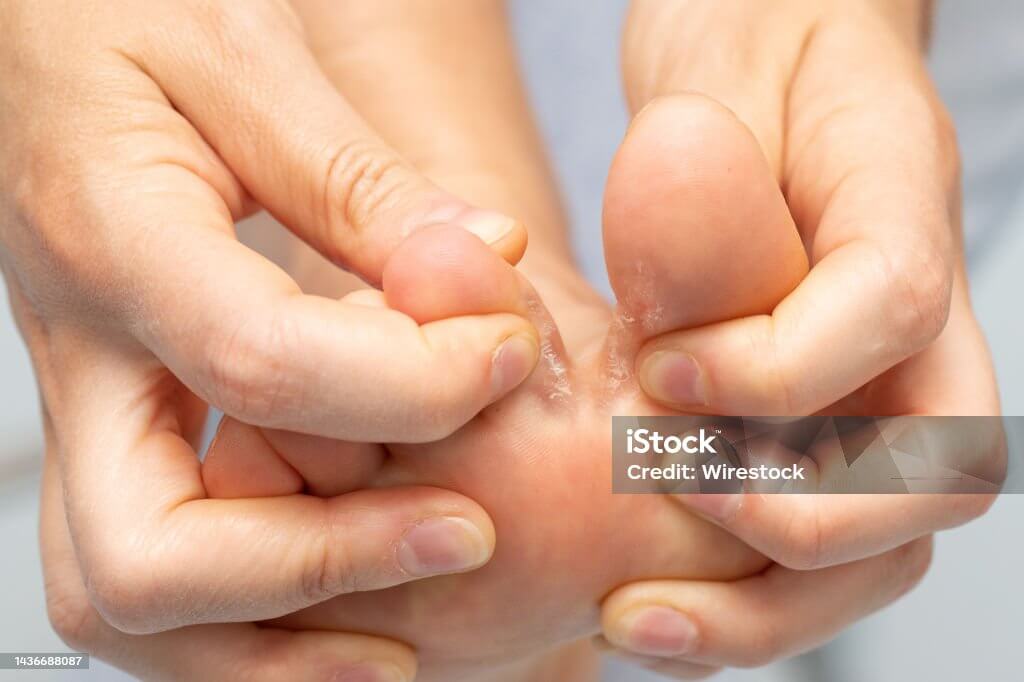 발무좀 없애는 방법, 증상, 예방법 및 민간 치료 요법(나만의)