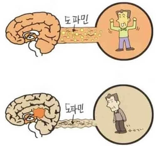 파킨슨 질환