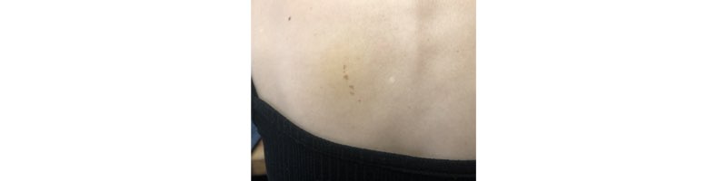 등뒤 왼쪽 기립근 부분에 모여있는 점들