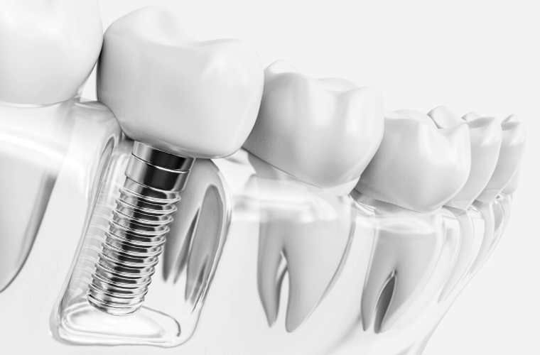 임플란트 가격 비용