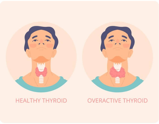 갑상선 기능 항진증에 대해 설명하는 그림