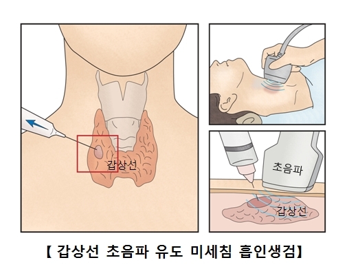 갑상선암 원인, 증상, 검사, 수술