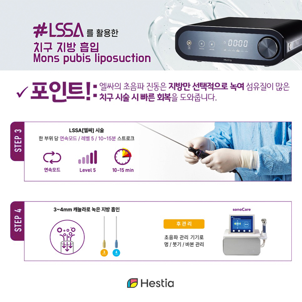 엘싸 시술 포인트