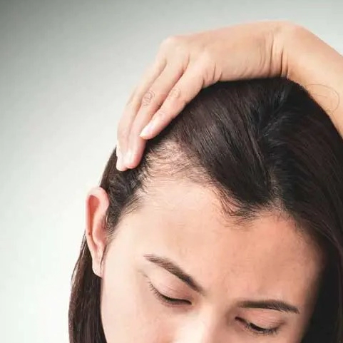 탈모 유전 확률 및 모계유전