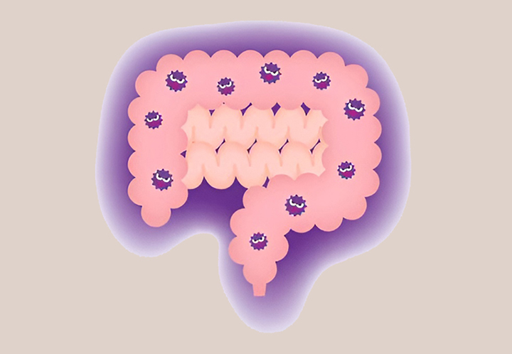 염증이-심한-장의-모습