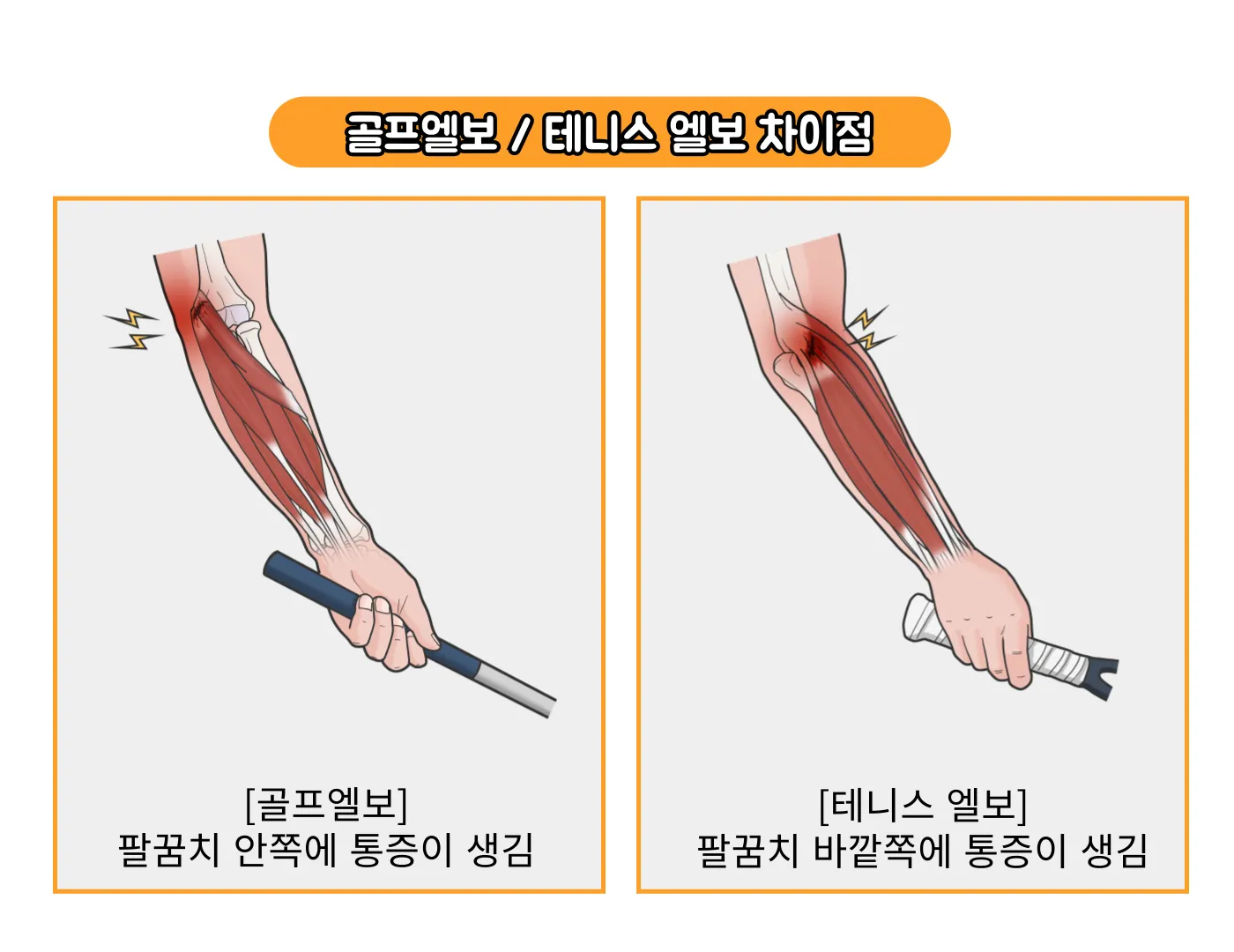 팔꿈치 통증 원인 6가지증상운동법예방법치료법까지_6