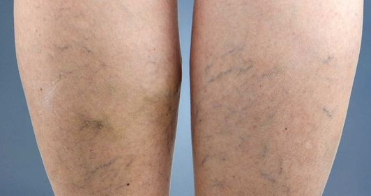 하지정맥류 증상 : 다리 혈관이 튀어 나와 보일 때