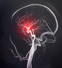 뇌경색 전조증상과 뇌졸중. 인간의 뇌는 우리 몸에서 가장 중요한 기관 중 하나입니다. 뇌를 통해 기억과 학습을 담당하고 신체 기관이 운동 기능을 수행할 수 있도록 하기 때문입니다. 뇌졸중과 뇌경색으로 심하게 손상되기 전까지는 일상생활에서 이상증상을 확인하기 어려우므로 평소에 주의를 하셔야 합니다.