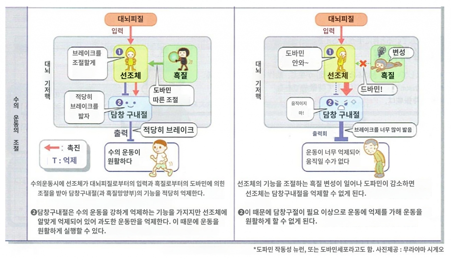 파킨슨뱡 줄기세포 치료