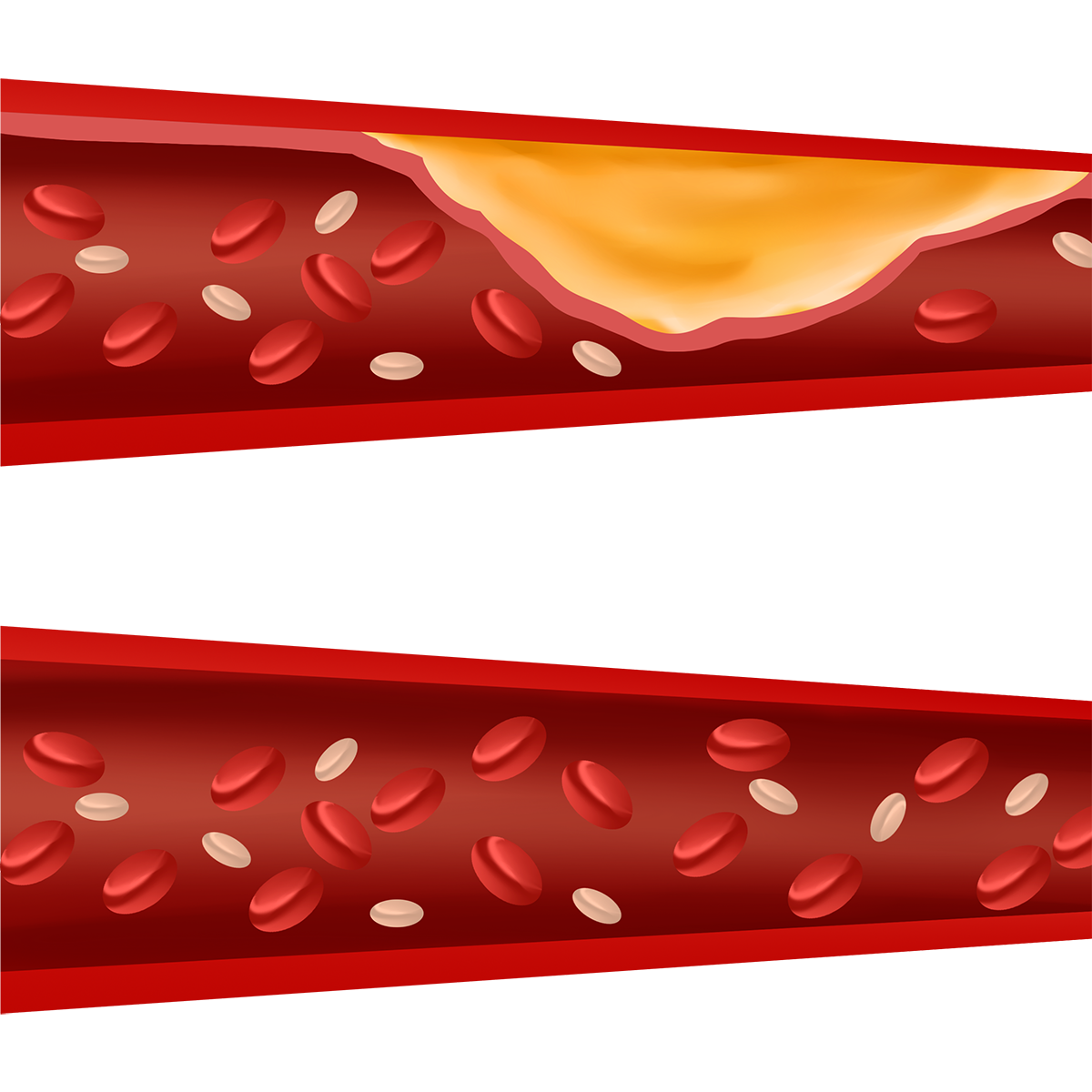 고밀도 콜레스테롤
