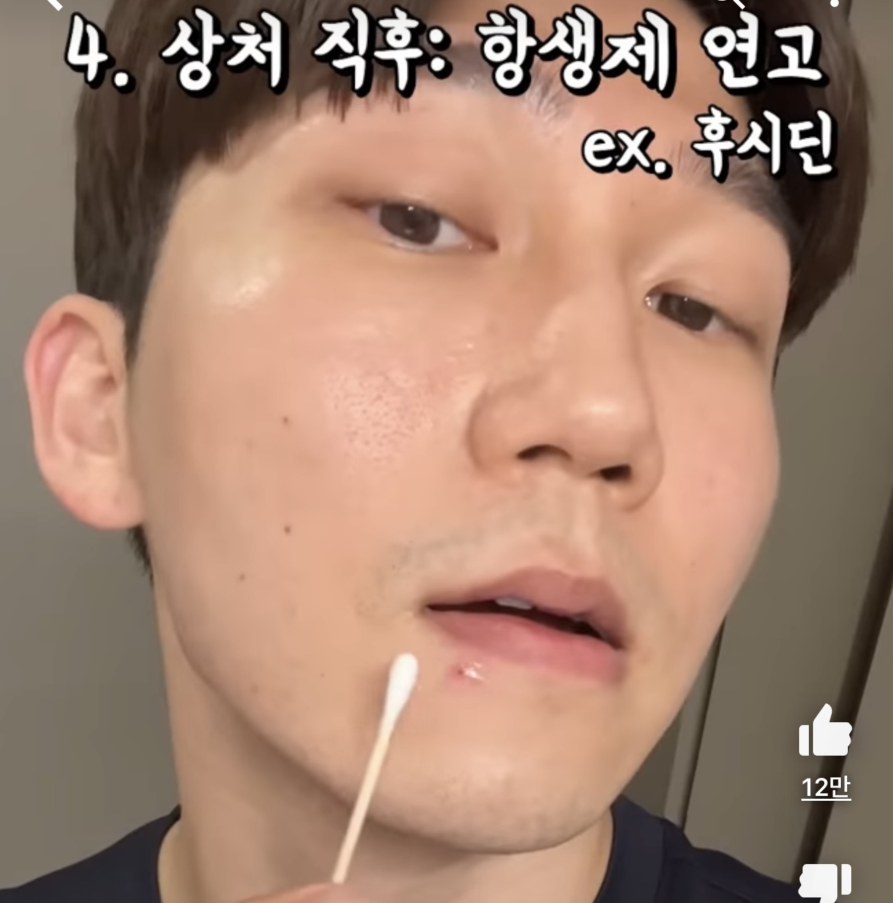 흉터 없이 여드름 짜는 방법