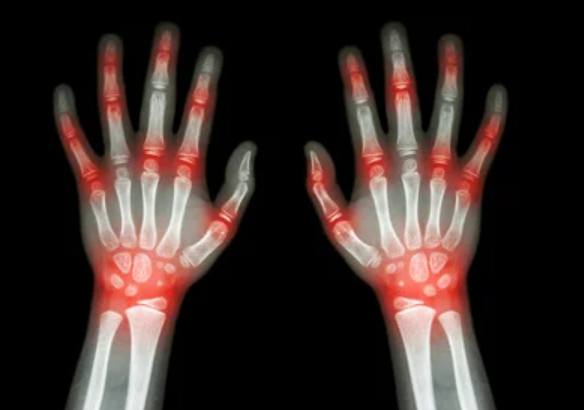 통풍 증상 - 만성 관절염