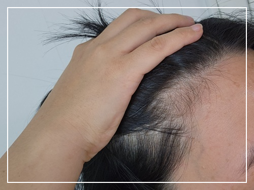 탈모 예방 방법 알아보고 예방