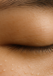 비립종 생기는 이유