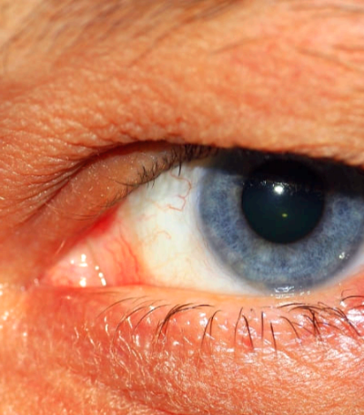 눈에 날파리 현상