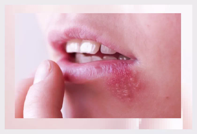 남자 성병 증상