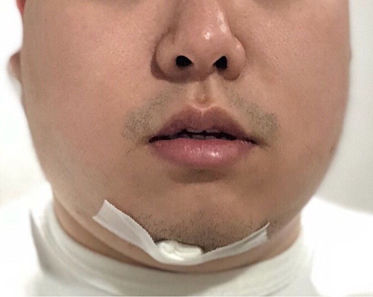 얼굴 지방흡입 후기