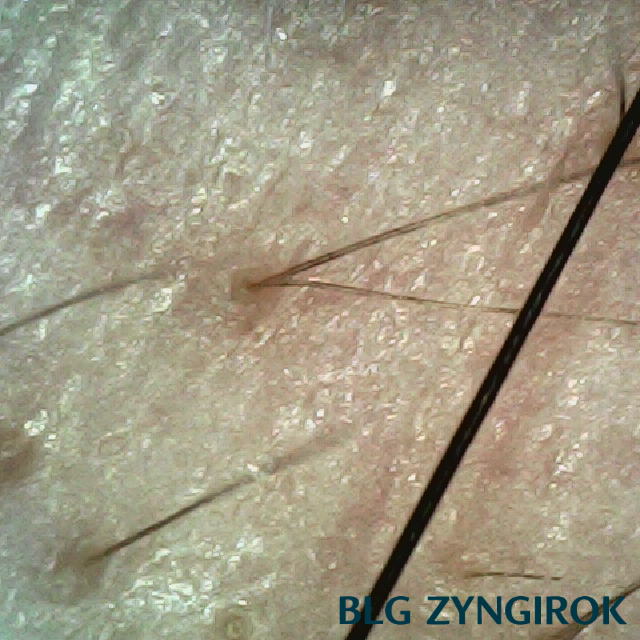 피나모아 복용 7주차 두피사진 - 오른쪽 M자 위치 모습이다.