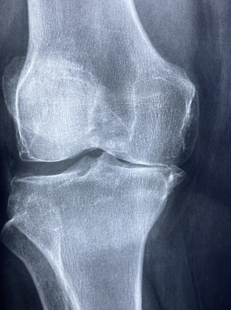 관절 관련 이미지, 무릎 관절 뼈