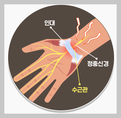손목터널증후군 증상, 원인, 운동법