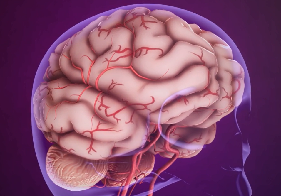 모야모야병 증상