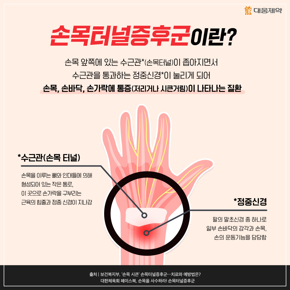 손목터널증후군(출처 대웅제약)