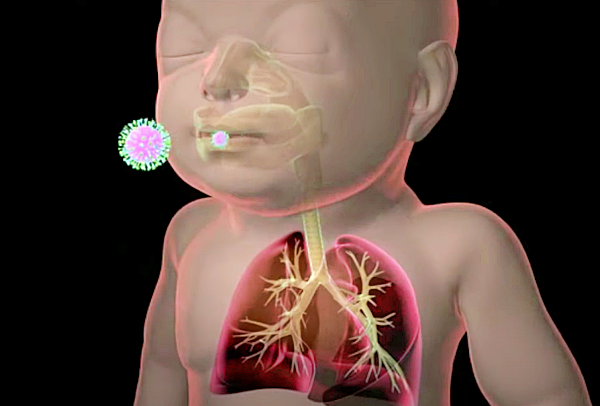 RSV 바이러스란?_출처:Cleveland Clinic
