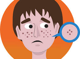 좁쌀 여드름 치료방법