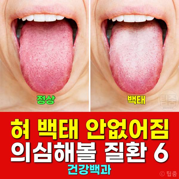 혀백태 원인 제거 혀 백태 안없어짐