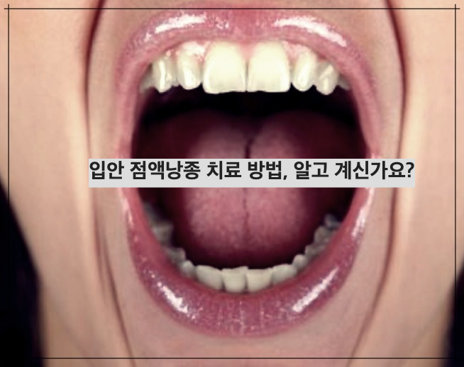 입안 점액낭종 치료 방법, 알고 계신가요?