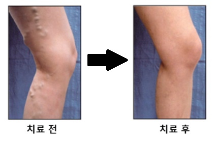 하지정맥류_레이저치료