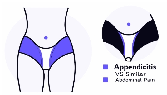 맹장염 증상과 비슷한 다른 질환