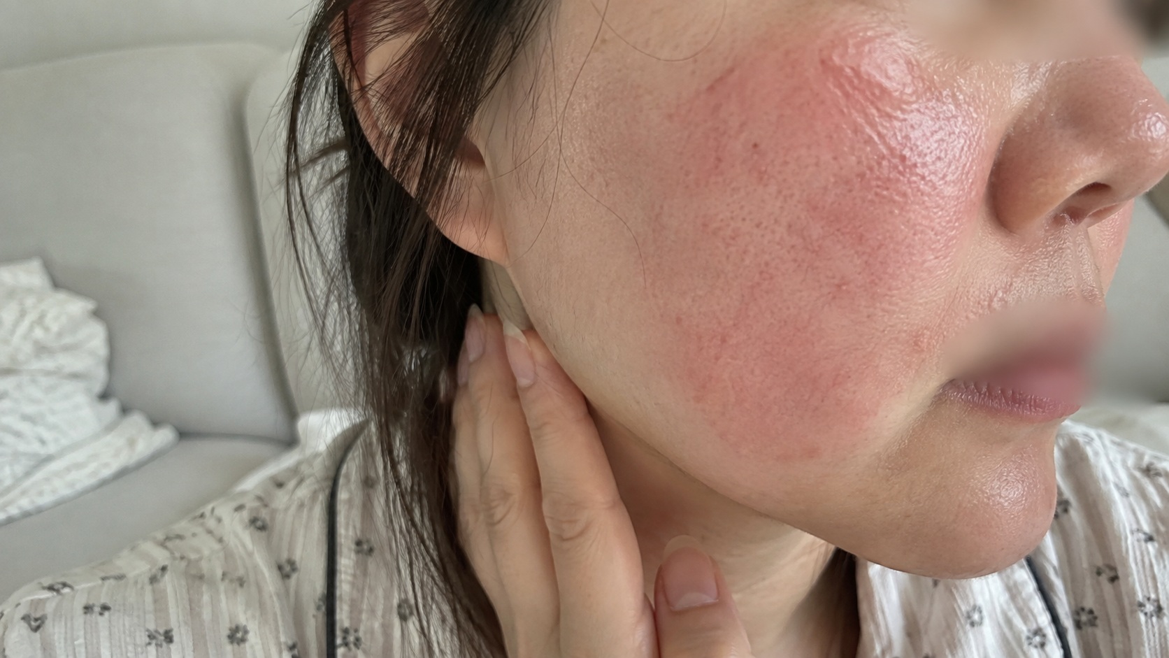 40대 갱년기 안면홍조와 피부 건조 증상이 나타난 볼 피부