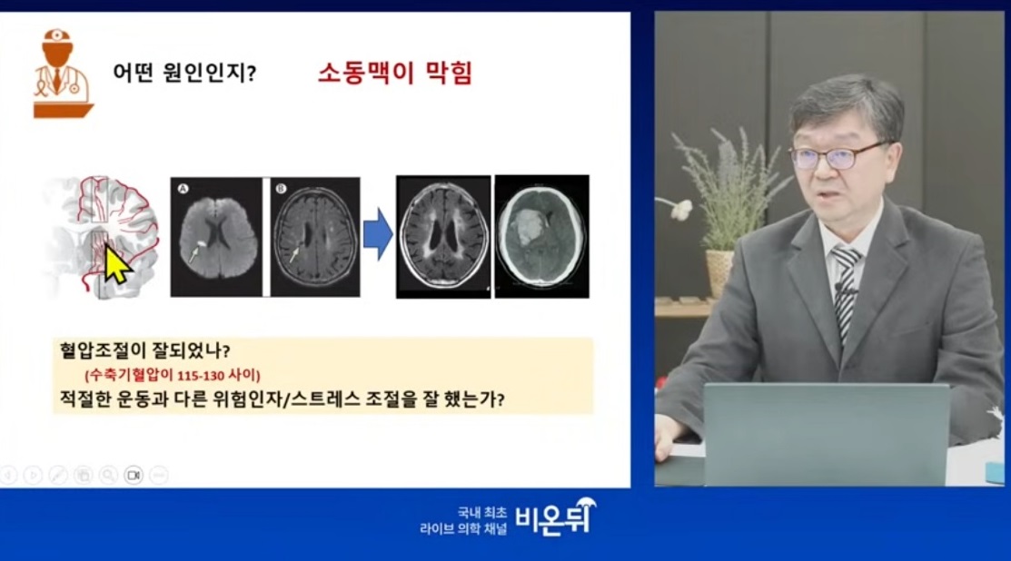 방오영-교수-경동맥이위험하다-뇌졸중-원인